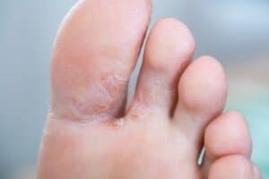 Athlete’s foot and blisters