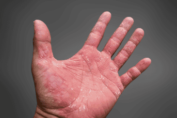 How Wearing Wet Gloves Can Affect Your Skin Health